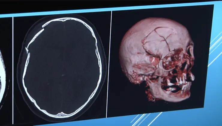ALERTAN SOBRE RIESGOS MORTALES DE TRAUMATISMO CRANEOENCEFÁLICO EN NIÑOS POR ACCIDENTES EN MOTOCICLETAS