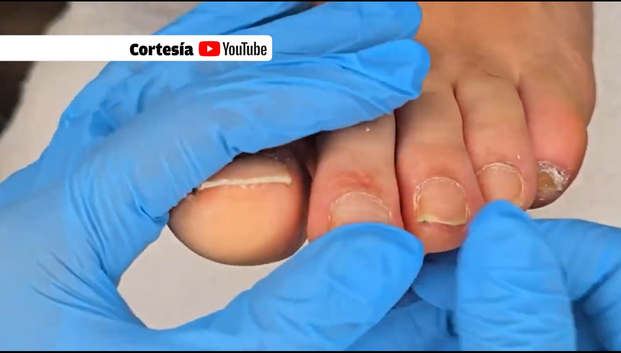 OTORGARAN PEDICURES CLINICOS GRATUITOS A PACIENTES CON CANCER